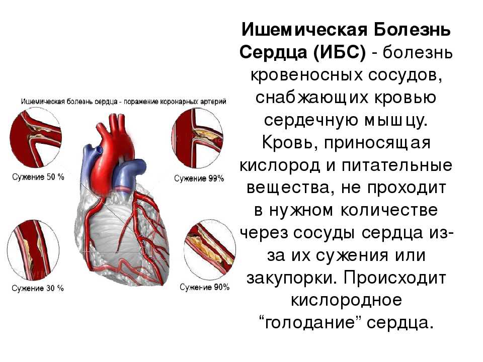 Ишемическая болезнь сердца, стенокардия и правила жизни. часть вторая.