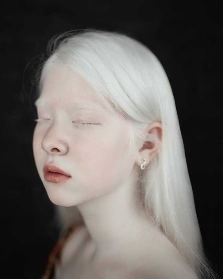 10 интересных фактов об альбиносах