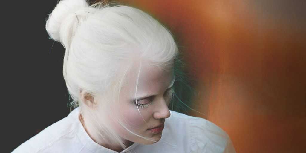 Кто такие люди-альбиносы? почему люди рождаются альбиносами?