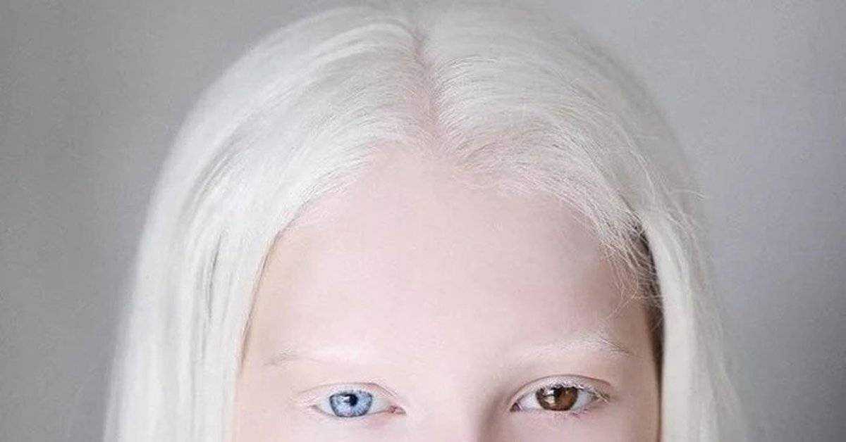 Кто такие альбиносы: посланники небес или люди с генетической аномалией