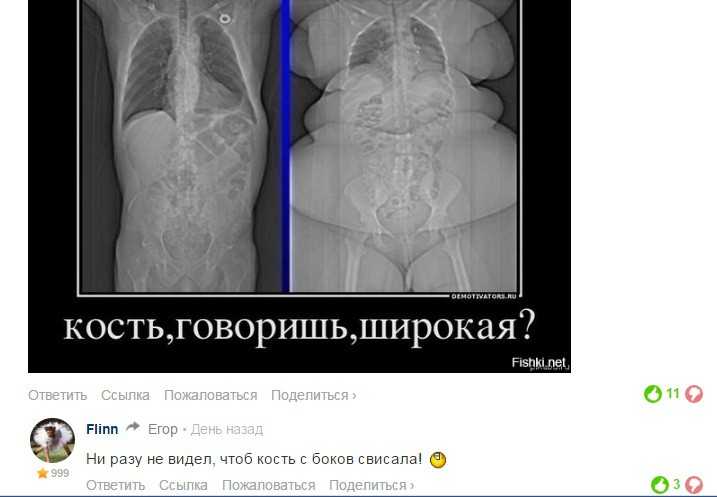 «жрите меньше». петрозаводский медик рассказал, бывает ли «широкая кость»