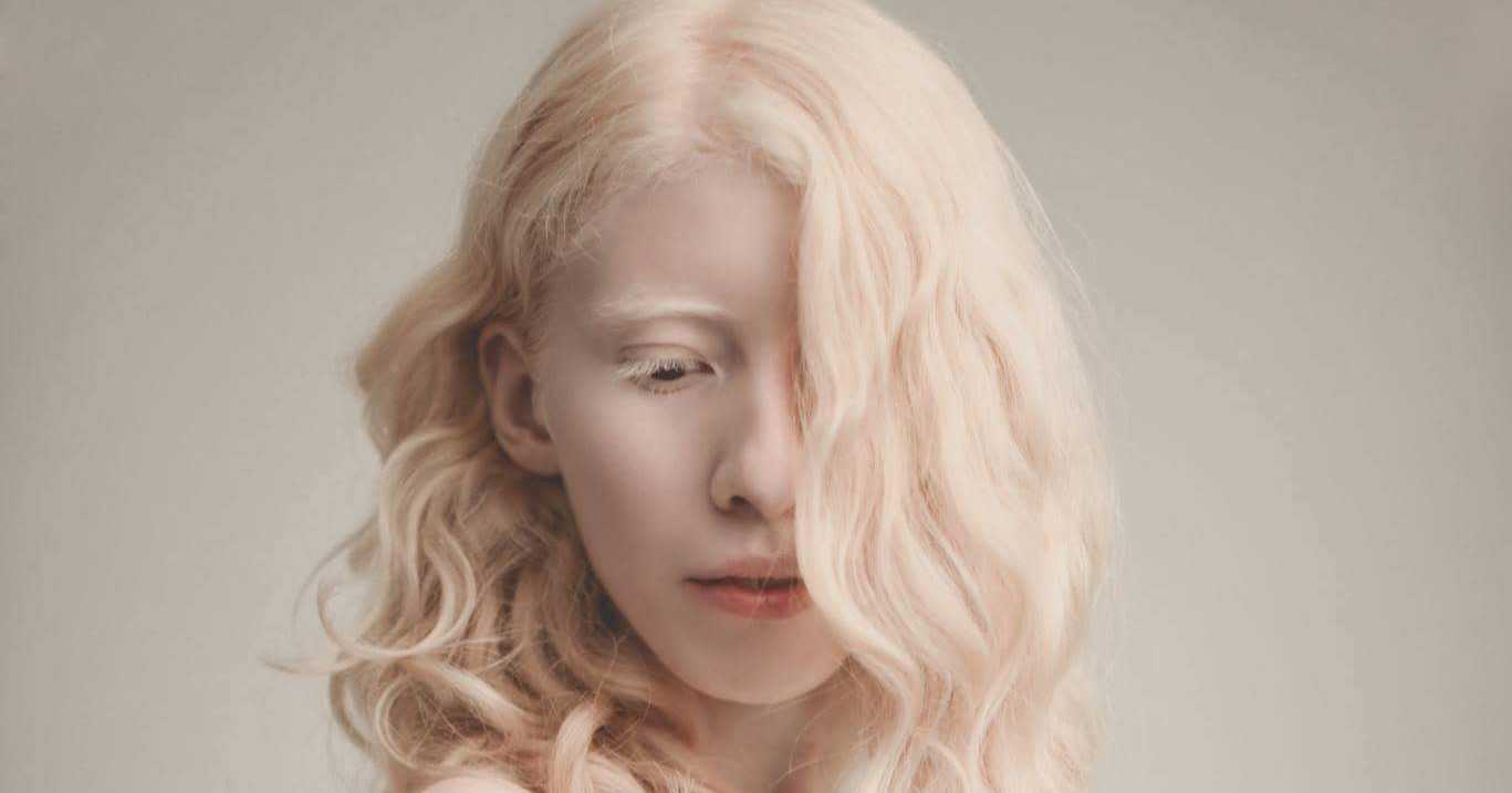 Альбинос - причины и признаки. негр альбинос – дар или наказание?