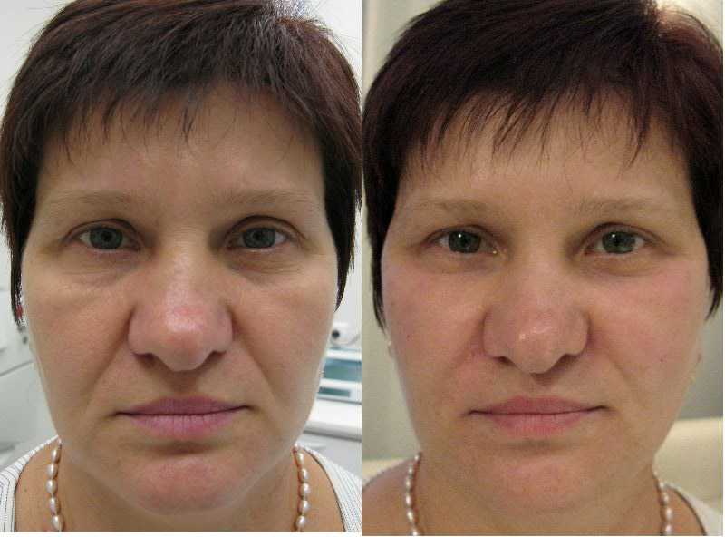 Эффект посещения косметолога: фото до и после