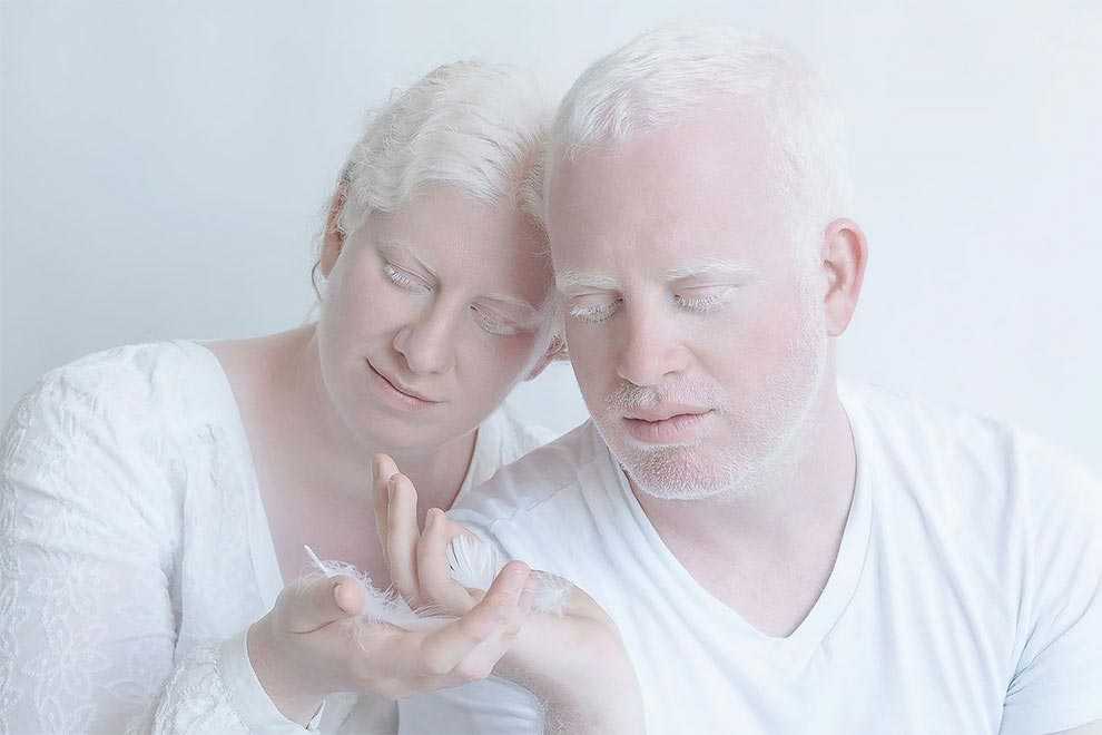 Люди-альбиносы: как выглядят и где живут, опасен ли альбинизм? - полисмед