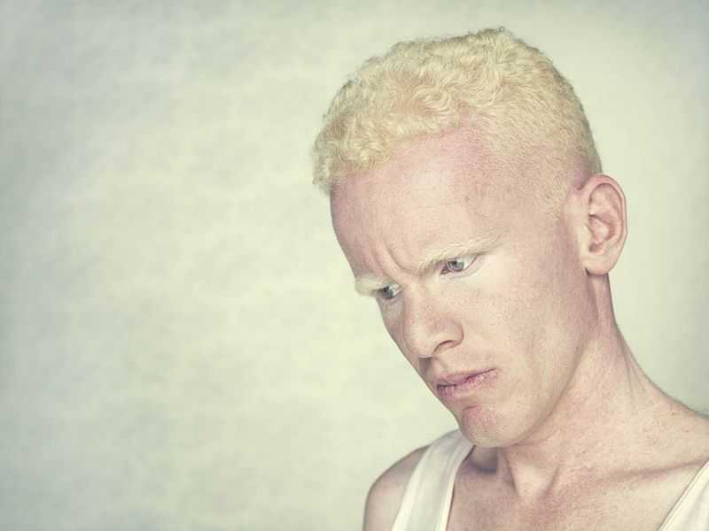 Интересные факты об альбиносах. топ-10