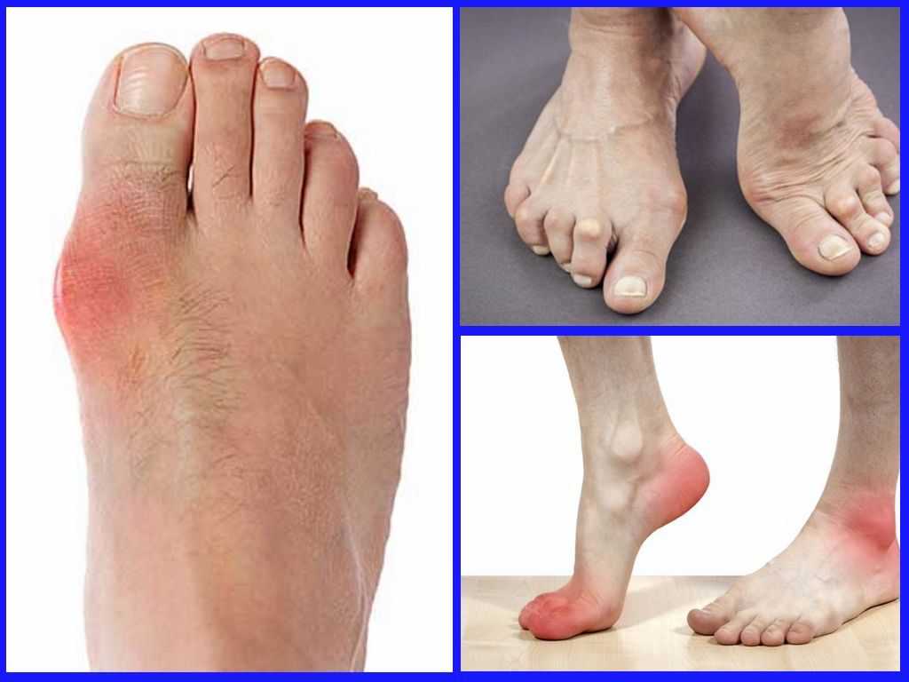 Слабость в ногах — чем может быть вызван этот симптом?